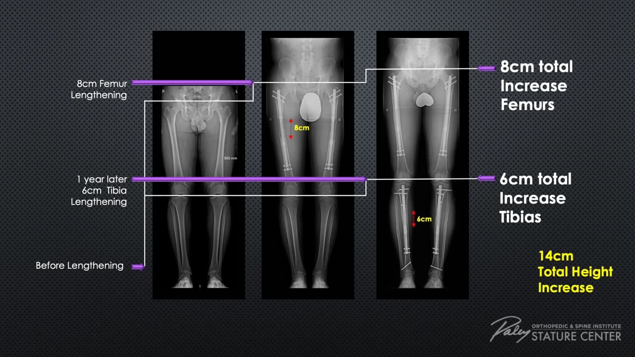 Femur Lengthening followed by Tibial Lengthening One Year Later
